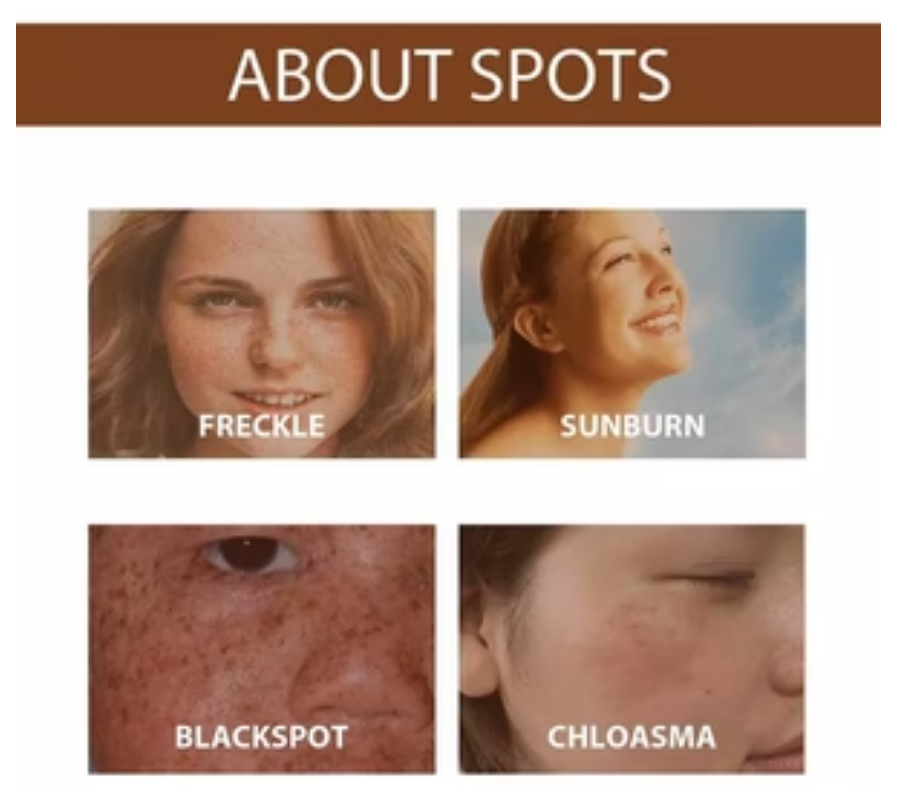 Hoygi Anti Freckle Serum